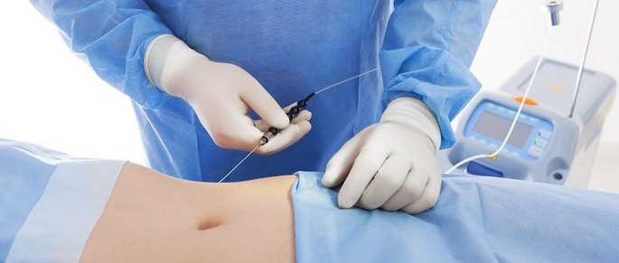 Learn More About Liposuction Surgery