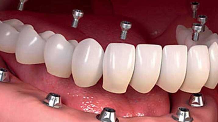 How much does it cost to replace all teeth with dental implants?