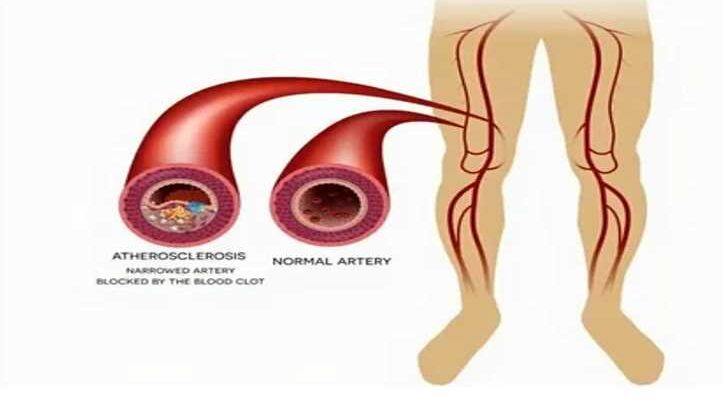 Learn More About the Vascular Disease