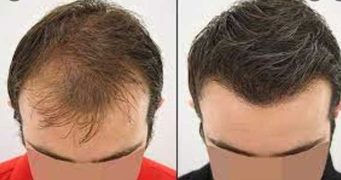 What Is The Success Rate Of Hair Transplant